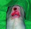 Risswunde subtibial